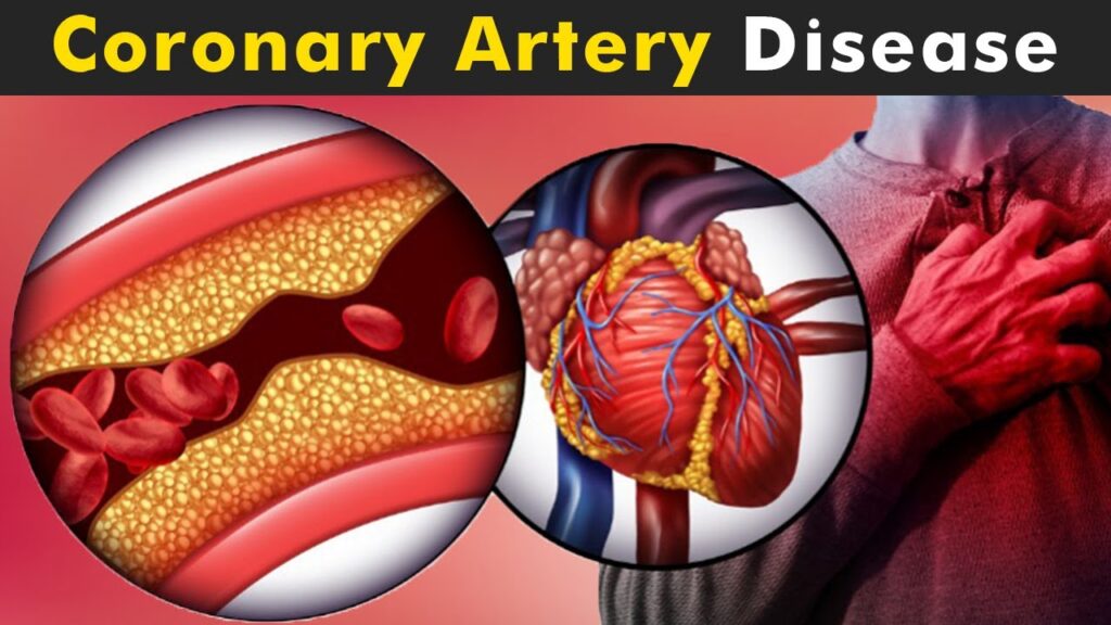 Understanding Coronary Artery Disease: Treatment and Management